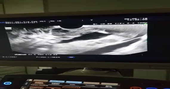 Özefagus varis kanaması olan hastamıza Endoskopik Ultrasonografi yöntemi ile coil(sentetik damar tıkacıyı) uygulanarak kanama durduruldu.